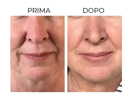 Cerbero Risultati Prima e Dopo 4